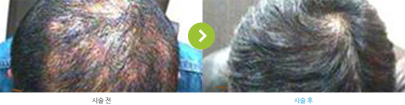 원형탈모의 시술 전/후 사진