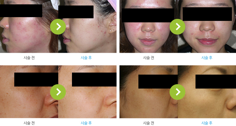 스펙트라골드 시술 전후 사진