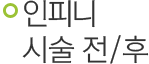 인피니 시술 전/후