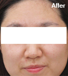 IPL 시술 후 사진