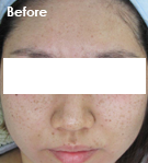 IPL 시술 전 사진