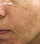 기미토닝 시술 전 사진