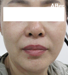 더블로 시술 후 사진