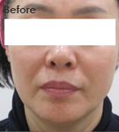 더블로 시술 전 사진