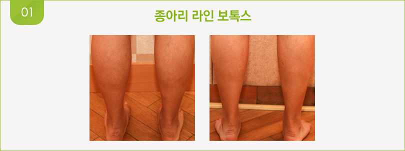 종아리 라인 보톡스 전후 사진